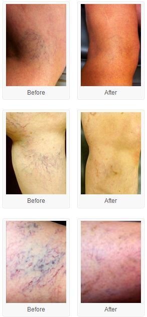 Sclerotherapy for Spider Veins - Mimi Lee M.D. PA