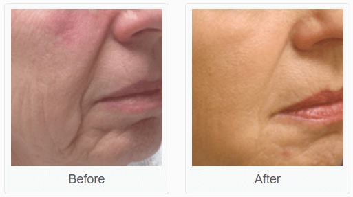frown line removal