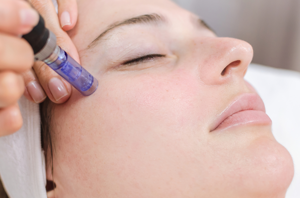 RF Microneedling